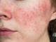 Rosacea behandeling wat te doen?