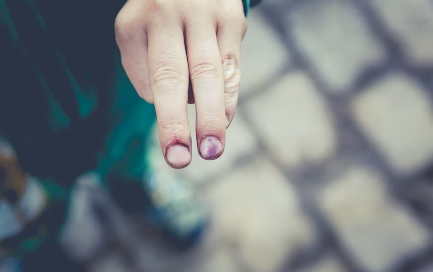 Blauwe plekken door bloedverdunners