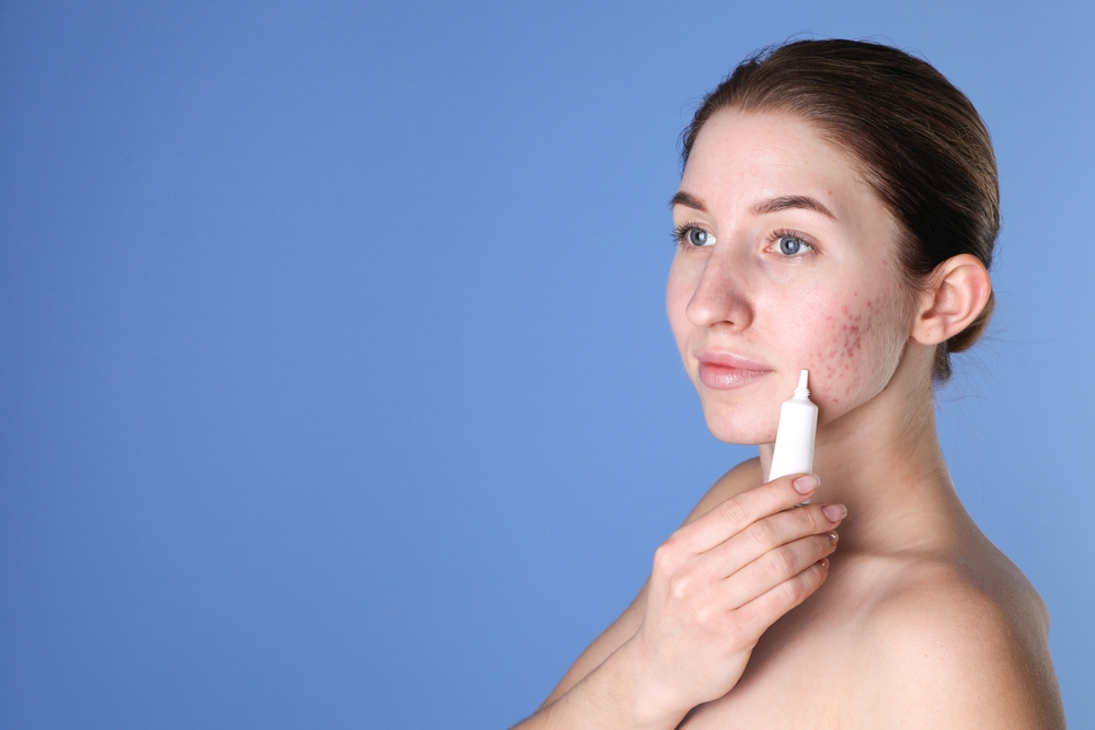 Vrouw met acne op haar wangen die duurzame huidverzorgingsproducten gebruikt om puistjes te verminderen.